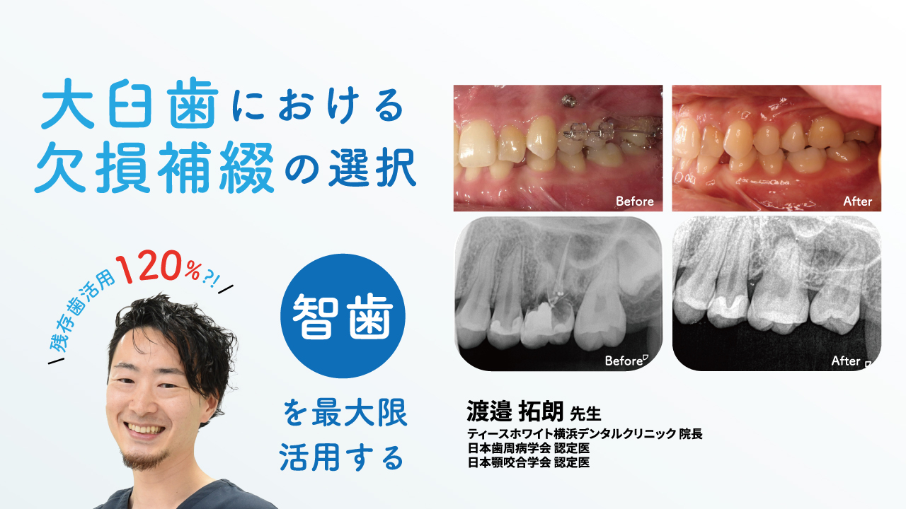 大臼歯における欠損補綴の選択~智歯を最大限活用する~の画像です。