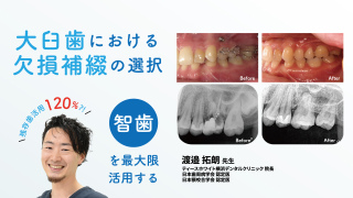 大臼歯における欠損補綴の選択～智歯を最大限活用する～の画像です。