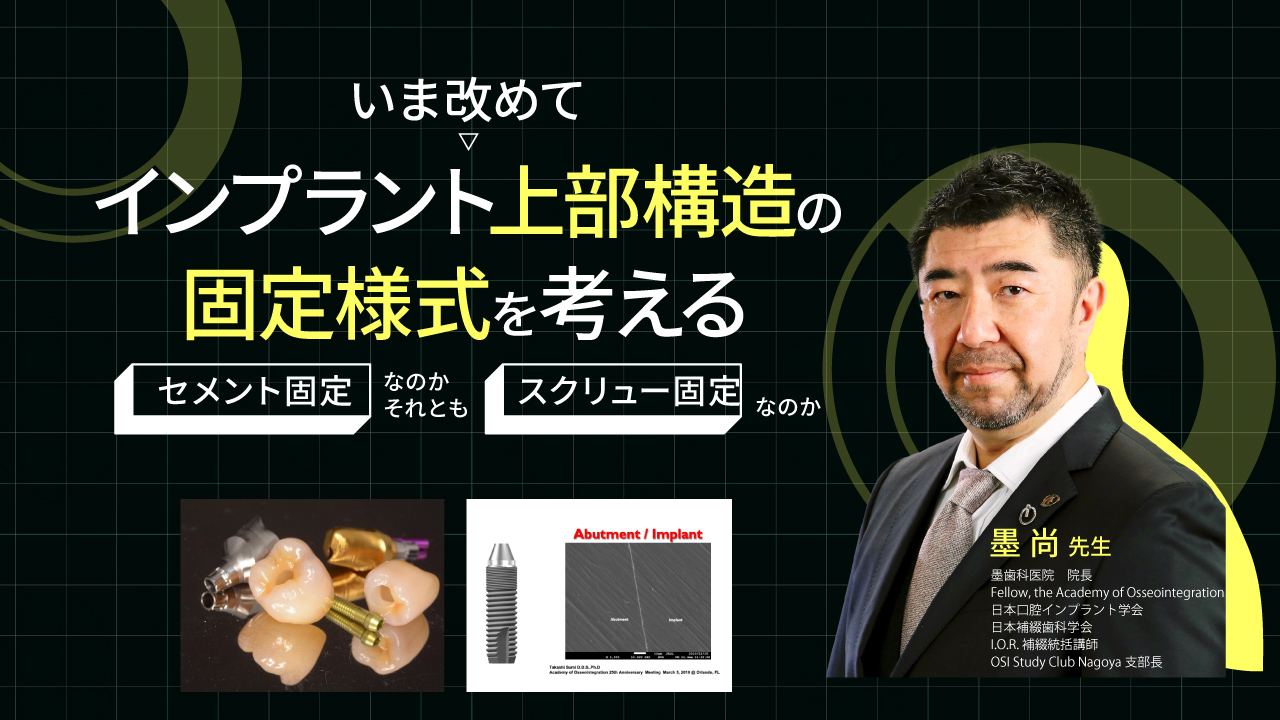 いま改めてインプラント上部構造の固定様式を考える〜セメント固定な