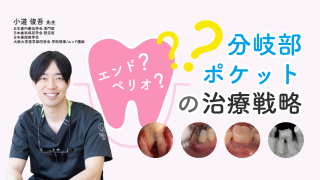 エンド？ペリオ？分岐部ポケットの治療戦略の画像です。