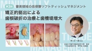 第3回 矯正的挺出による歯根破折の治療と歯槽堤増大の画像です。