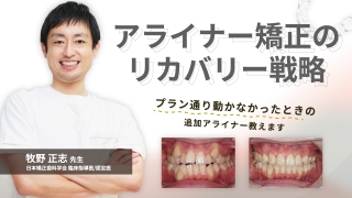 アライナー矯正のリカバリー戦略の画像です。