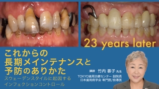 これからの長期メインテナンスと予防のありかた 〜スウェーデンスタイルに起因するインフェクションコントロールの画像です。