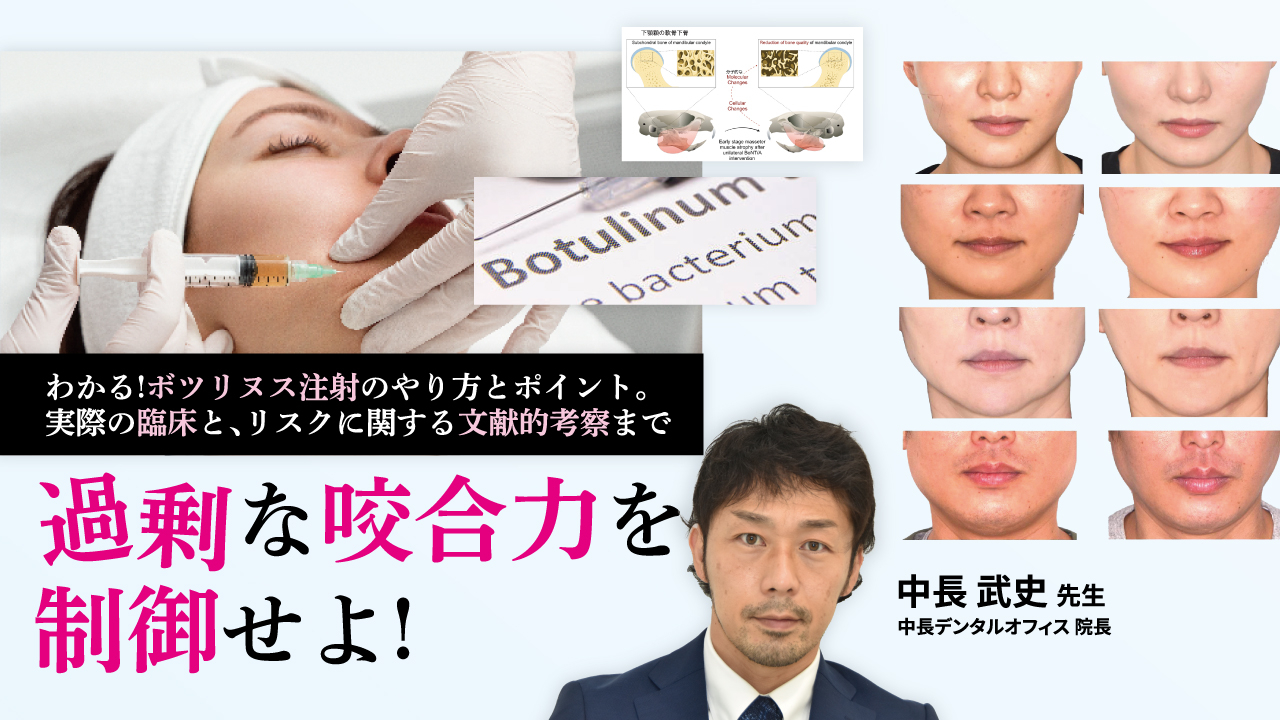 過剰な咬合力を制御せよ!〜わかる!ボツリヌス注射のやり方とポイント。実際の臨床と、リスクに関する文献的考察まで〜の画像です。