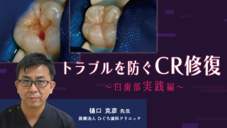 トラブルを防ぐCR修復〜臼歯部実践編〜の画像です。