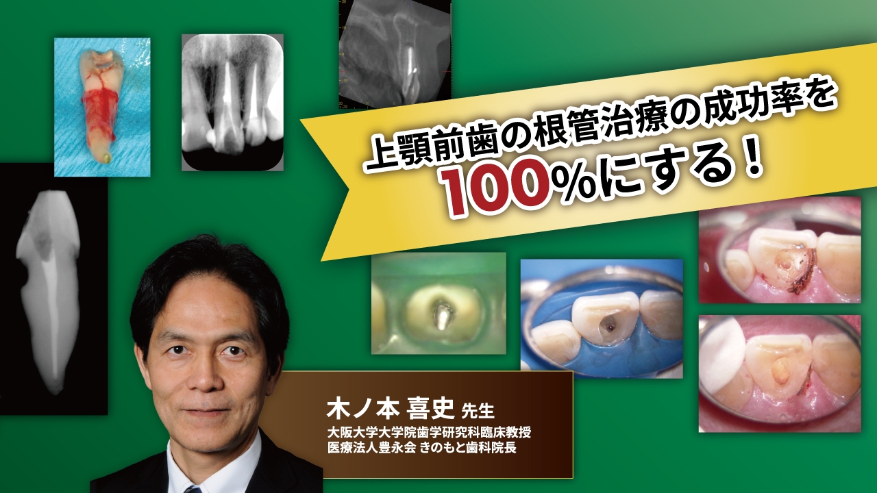 ホワイトのインプラント上部構造 [単行本] グラハム・E. ホワイト、 White，Graham E.; 芳信， 前田 補綴臨床別冊 知っておくべきインプラントオーバーデンチャー