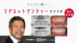 パーシャルデンチャー成功のための設計3原則　動かない 汚さない 壊れない パーシャルデンチャー成功のための設計3原則 動かない 汚さない