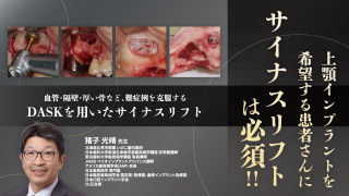 上顎インプラントを希望する患者さんにサイナスリフトは必須！！〜血管・隔壁・厚い骨など、難症例を克服するDASKを用いたサイナスリフト〜の画像です。