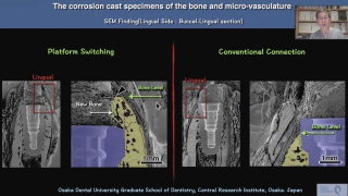 第6回　歯周病専門医が考えるインプラント治療の画像です。