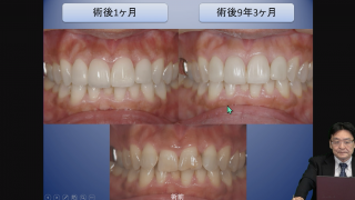第1回　前歯のBTAテクニック®とシーリングコンセプトの画像です。