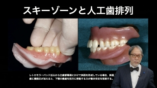 【第1回】そうなのか！すんなり収まる総義歯のテクニックの画像です。