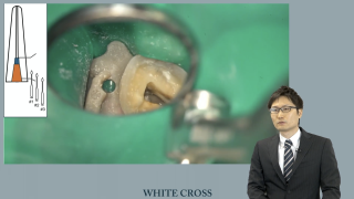 根管治療難症例への挑戦！〜レッジ、彎曲根管、狭窄根管の攻略〜の画像です。