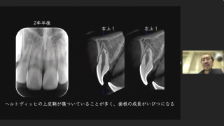 外傷歯の診断と治療〜その根管治療は必要ですか？〜 | WHITE CROSS