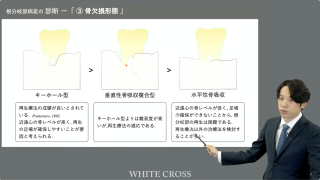 治してみたくなる！根分岐部病変〜歯周組織再生療法を中心とした外科的