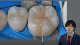 患者の意識改革に繋がるダイレクトボンディングの画像です。