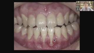 第5回　歯周治療と補綴治療の接点の画像です。