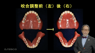 【第2回】今度こそわかる！義歯の咬合調整 超完全修得ノートの画像です。