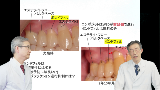 【第1回】スーパーボンドの基本と「スーパーボンドEX」の画像です。