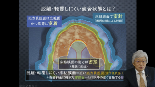 確実に患者満足度が上がる！“リンゴ丸かじりができる”全部床義歯