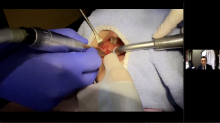 埋伏智歯抜歯をはじめてみよう～基礎編～の画像です。