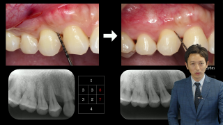 マサヨシ　裁断済み　歯周・インプラント治療における再生療法 歯周・インプラント治療における再生療法 - クインテッセンス出版
