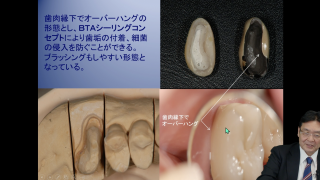 第2回　臼歯、インプラントのBTAテクニック®と歯周病学的応用の画像です。