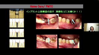 プラークコントロールと歯周病 縁下プラークの抑制 ペリオインスツルメーション プラークコントロールと歯周病 縁下プラークの抑制 ペリオインスツル