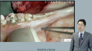 有茎弁歯肉移植術、ならびに結合組織移植術を用いた根面被覆術の画像です。