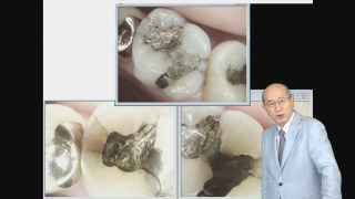 咬合と歯内療法の画像です。