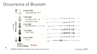 【第1回】シークエンシャル咬合とブラキシズムの関係の画像です。