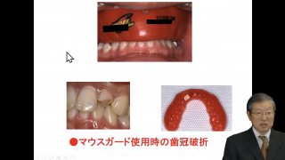 最新・安全性の高いマウスガード　背景・必要性と設計・制作法の画像です。
