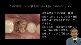 CEREC治療におけるアドヒーシブティストリー〜長期予後の鍵をにぎる〜の画像です。