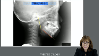 咬合崩壊しないための小児期からの準備の画像です。