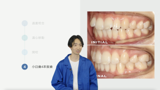 Dr.岡野が選ぶ！アライナーを用いた症例4選！～症例別、成功に導く4keys～の画像です。