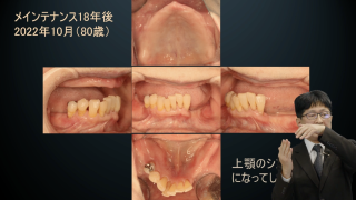 【第2回】「上減の歯列」を攻略せよ！の画像です。
