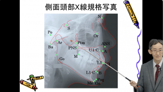 混合歯列期の矯正歯科治療　第1回　上顎前突編の画像です。