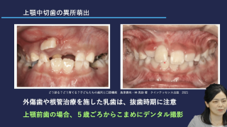 見逃してはいけない子どもの萌出障害の画像です。