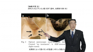 意外と知られていない！？フッ化ジアンミン銀を活用した新たな根面う蝕