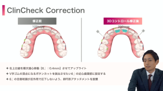 アライナー矯正の戦略 抜歯症例のフィニッシングの画像です。