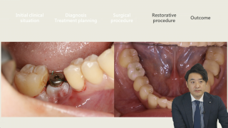 成功する人の骨移植〜GBRを成功させるための診断と治療戦略〜の画像です。
