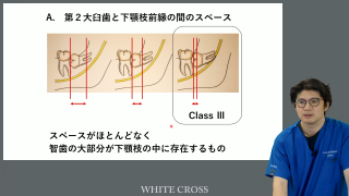 最小侵襲のMI 上下8智歯抜歯の画像です。