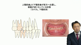 先生、舌位が治りません MFT＋姿勢からアプローチする舌位の画像です。