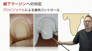 第1回 CAD/CAMオールセラミック修復の診断・形成・接着の画像です。