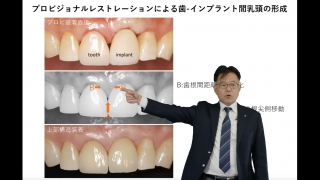 第1回 コンポジットレジン・ベニア修復によるブラックトライアングルの治療の画像です。