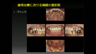 歯周補綴～歯が残ったその後に～の画像です。
