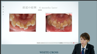 歯科衛生士が気づく口腔機能低下の予兆～口腔内崩壊の黒幕のしっぽをつかめVer.～の画像です。