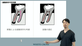 エンド？ペリオ？分岐部ポケットの治療戦略 | WHITE CROSS