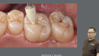 アウーノの達人Dr.竹内が、コンポジットレジンの悩みに線を引くの画像です。