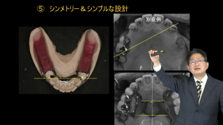 【第1回】パーシャルデンチャー設計の原点と難症例へのシンプルアプローチの画像です。