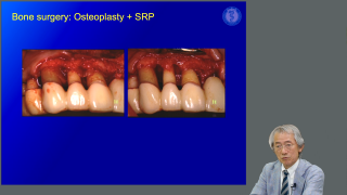 Dr.弘岡が語る！スカンジナビアンアプローチの真髄の画像です。